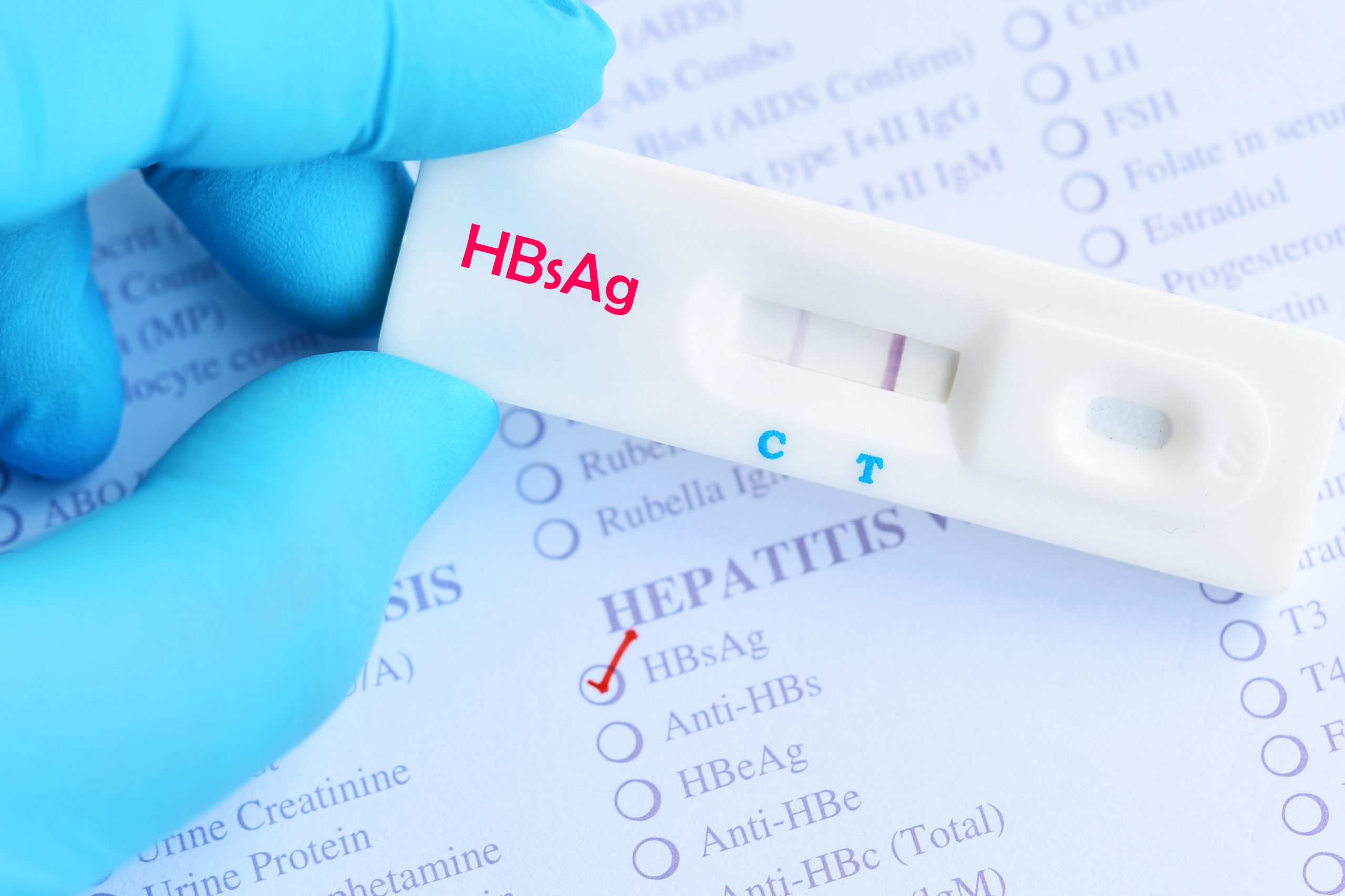 Depistage du virus de l'hépatite B par TROD VHB et au laboratoire