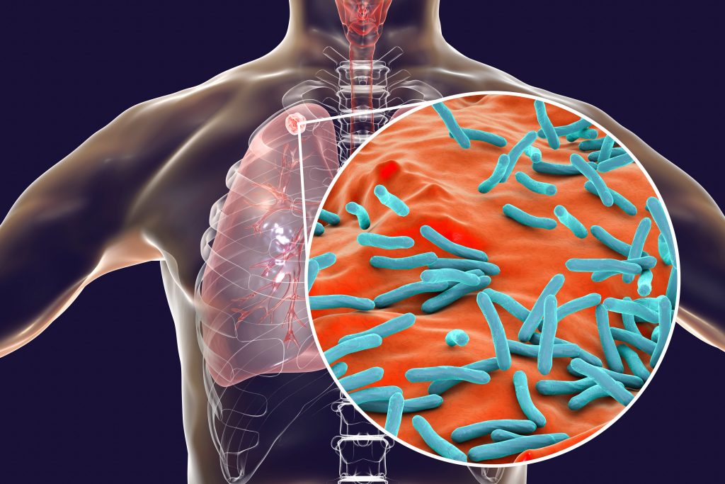 Synthèse sur la tuberculose en Europe : Diagnostic et antibiogramme